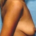 Breast Augmentation Before & After Patient #690