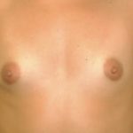 Breast Augmentation Before & After Patient #688