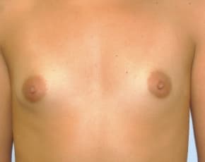 Breast Augmentation Before & After Patient #688