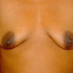 Breast Augmentation Before & After Patient #687