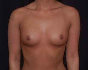 Breast Augmentation Before & After Patient #686