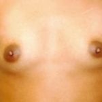 Breast Augmentation Before & After Patient #685