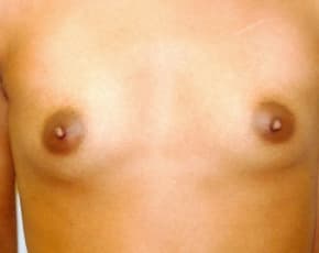 Breast Augmentation Before & After Patient #685