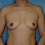 Breast Augmentation Before & After Patient #684