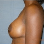 Breast Augmentation Before & After Patient #683