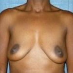 Breast Augmentation Before & After Patient #683
