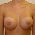Breast Augmentation Before & After Patient #682