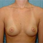 Breast Augmentation Before & After Patient #682
