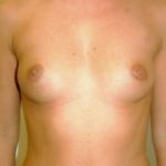 Breast Augmentation Before & After Patient #681
