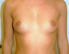 Breast Augmentation Before & After Patient #681