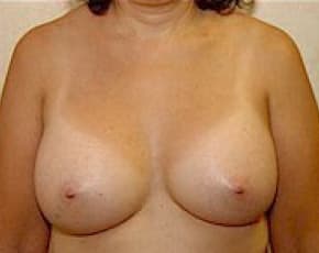 Breast Augmentation Before & After Patient #680