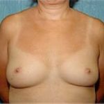 Breast Augmentation Before & After Patient #680