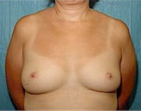 Breast Augmentation Before & After Patient #680
