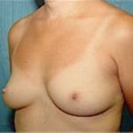 Breast Augmentation Before & After Patient #680