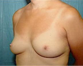 Breast Augmentation Before & After Patient #680