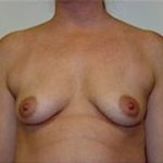 Breast Augmentation Before & After Patient #679