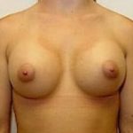 Breast Augmentation Before & After Patient #677