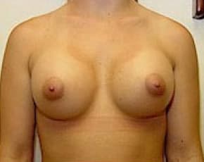 Breast Augmentation Before & After Patient #677