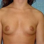Breast Augmentation Before & After Patient #677