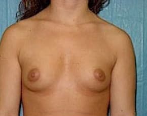 Breast Augmentation Before & After Patient #677