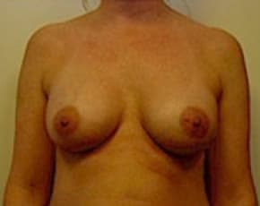 Breast Augmentation Before & After Patient #676
