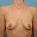 Breast Augmentation Before & After Patient #676