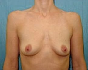 Breast Augmentation Before & After Patient #676