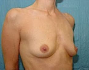 Breast Augmentation Before & After Patient #676