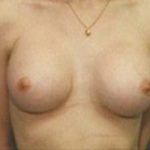 Breast Augmentation Before & After Patient #675