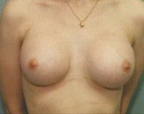 Breast Augmentation Before & After Patient #675