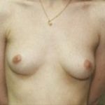 Breast Augmentation Before & After Patient #675