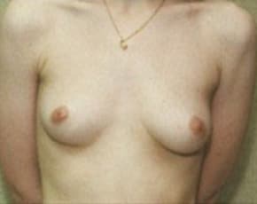 Breast Augmentation Before & After Patient #675