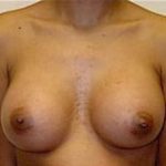 Breast Augmentation Before & After Patient #674