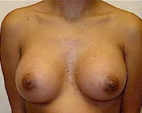 Breast Augmentation Before & After Patient #674