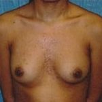 Breast Augmentation Before & After Patient #674