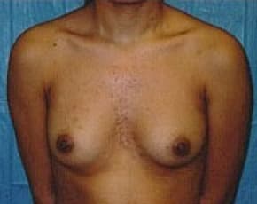 Breast Augmentation Before & After Patient #674