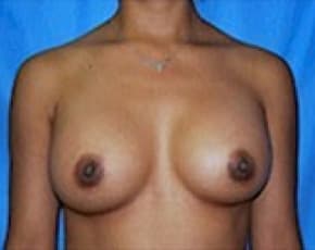 Breast Augmentation Before & After Patient #669