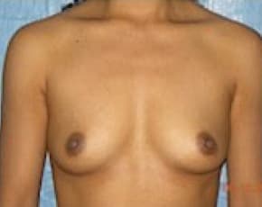 Breast Augmentation Before & After Patient #669