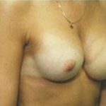 Breast Augmentation Before & After Patient #667