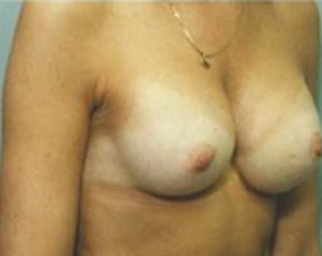 Breast Augmentation Before & After Patient #667