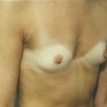 Breast Augmentation Before & After Patient #667
