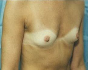 Breast Augmentation Before & After Patient #667
