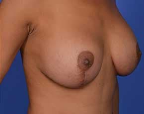 Breast Lift With Implants Before & After Patient #742
