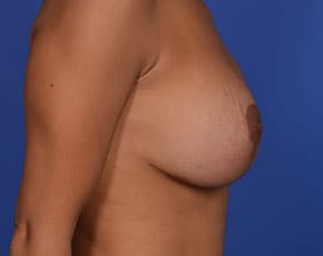 Breast Lift With Implants Before & After Patient #742