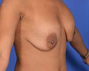 Breast Lift With Implants Before & After Patient #742