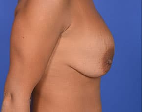 Breast Lift With Implants Before & After Patient #742