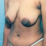 Breast Lift With Implants Before & After Patient #739