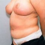 Breast Lift With Implants Before & After Patient #738