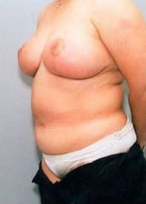 Breast Lift With Implants Before & After Patient #738