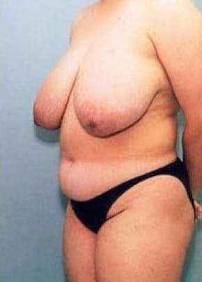 Breast Lift With Implants Before & After Patient #738